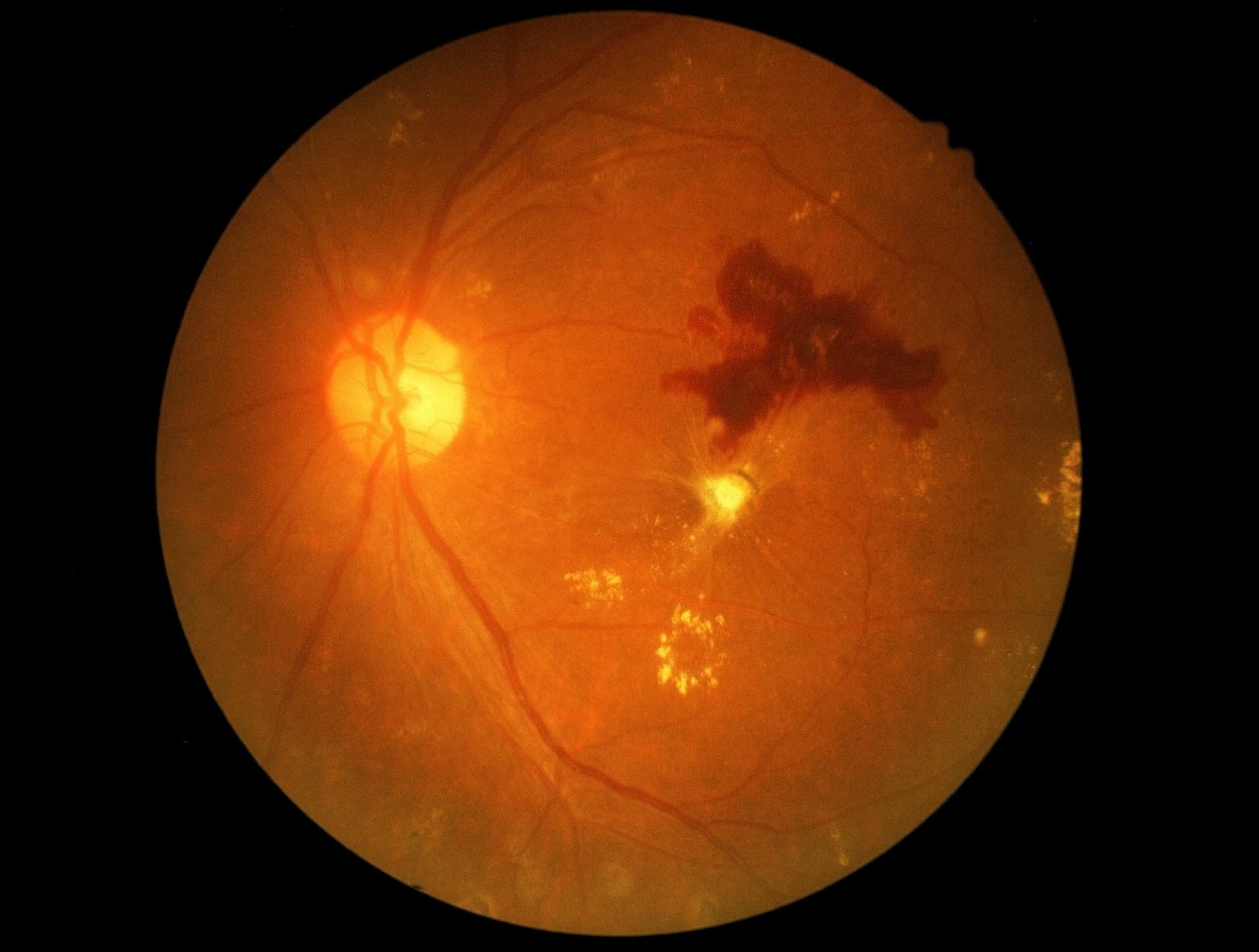 Retina of diabetic - diabetic retinophaty