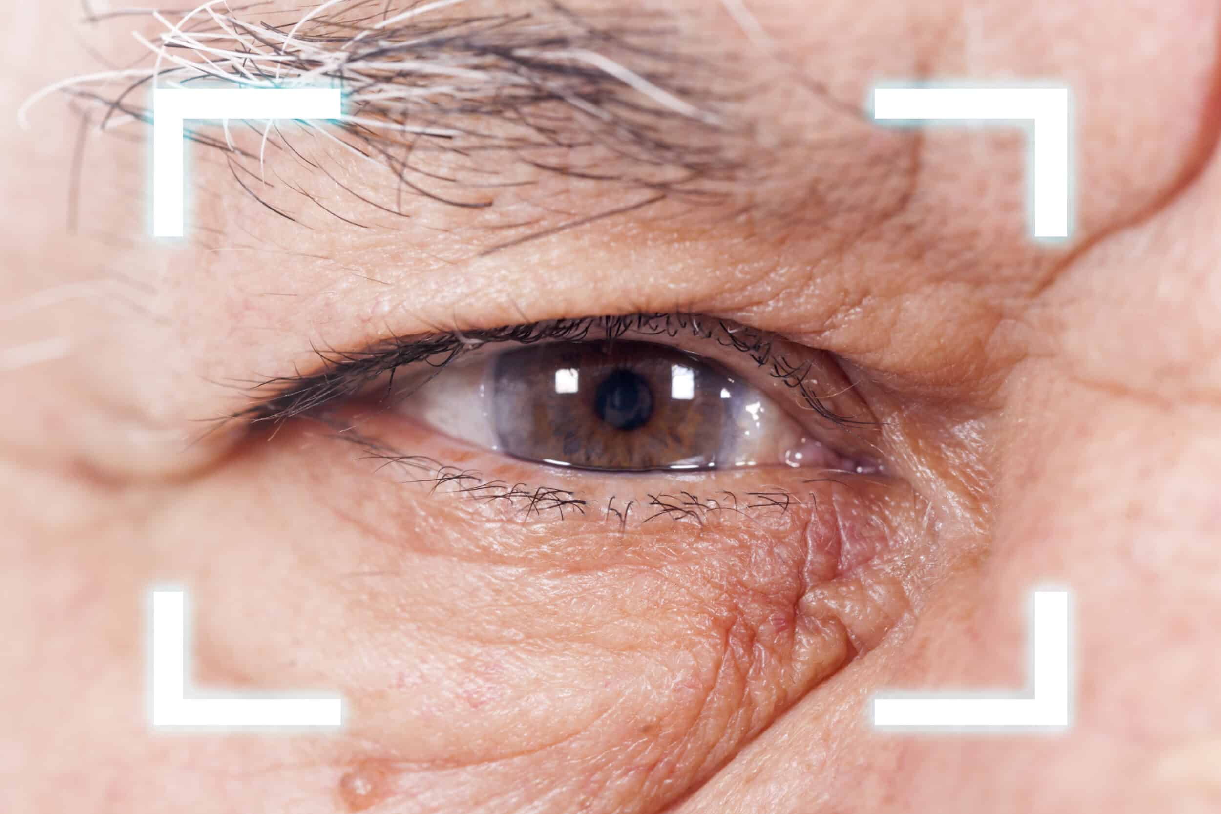 cataract surgery recovery wakefield ma
