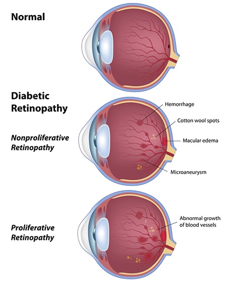 diabetic retinopathy diagram winchester ma