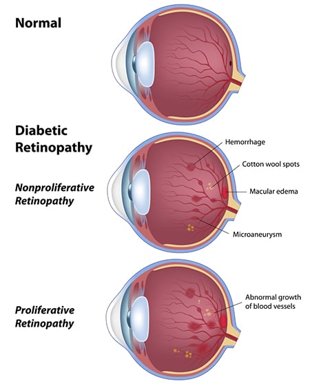 diabetic retinopathy