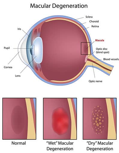 macular degeneration diagram wakefield ma