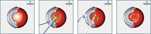 cataract surgery procedure wakefield ma