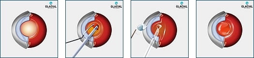 cataract surgery new