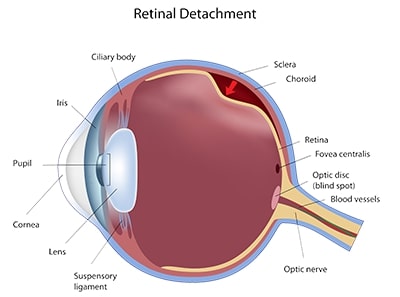 Boston retinal detachment treatment
