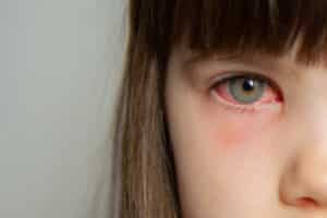 Pink eye Conjunctivitis in a girls eye