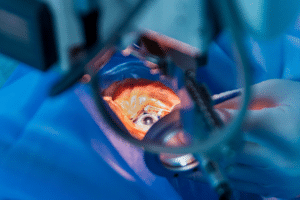 cataract surgery