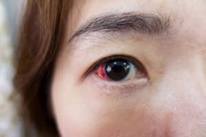 A close-up shot of a red, injured eye