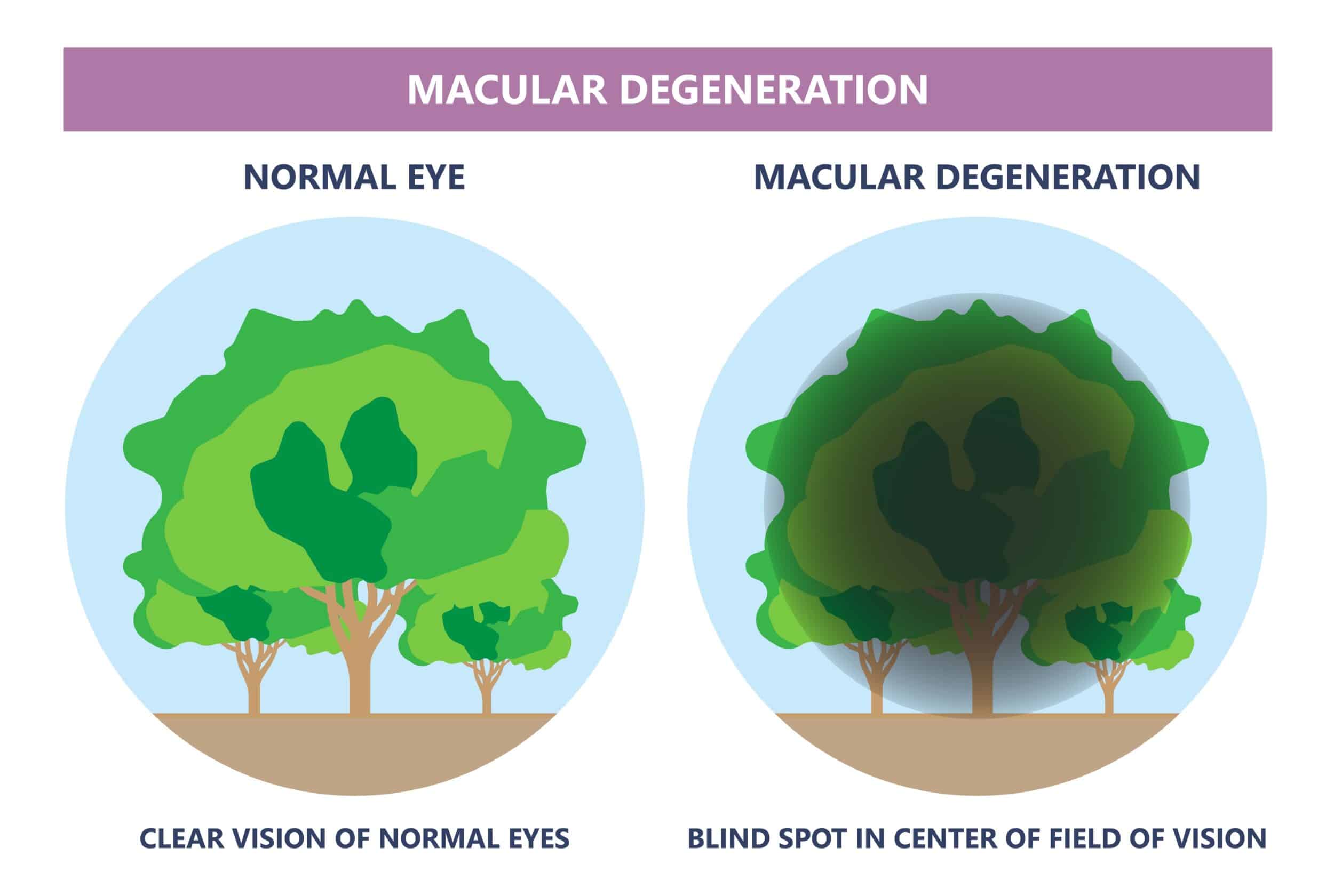 macular degeneration symptoms wakefield ma
