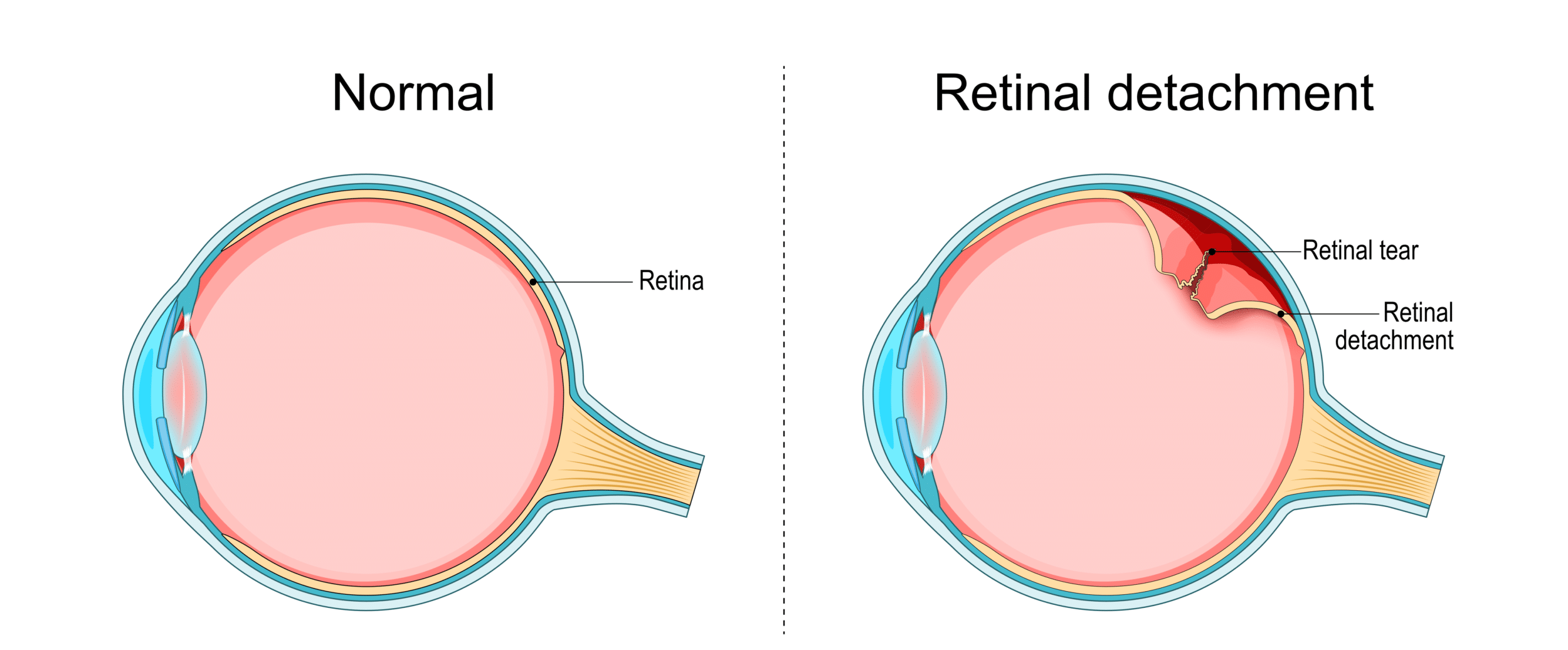 Illustrated diagram compares a healthy eye to an eye with retinal detachment