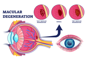 Diagram of healthy eye, an eye with wet AMD, and an eye with dry AMD